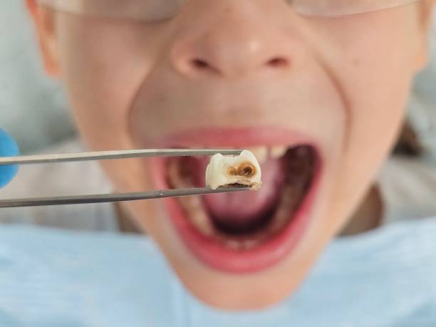 Best Teeth Whitening  in Carthage, IL